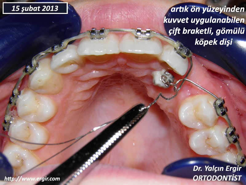 Tek Dise Cift Braket Dr Yalcin Ergir Ortodontist