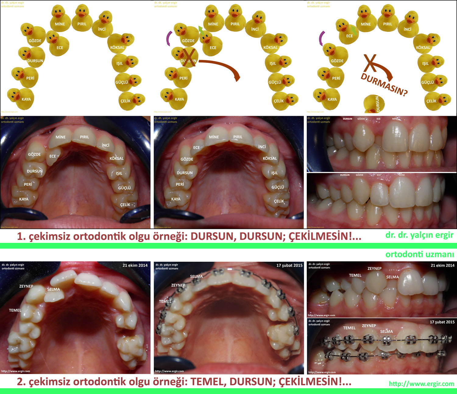 Ortodontide Tercihler Teknikler Bir Ortodonti Masali Dr Dt Yalcin Ergir Dus Hekimi