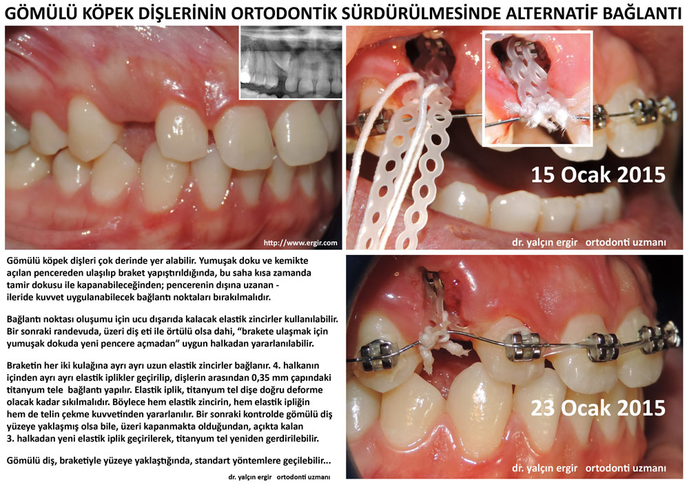 Gomulu Kopek Dislerinin Ortodontik Surdurulmesinde Alternatif Baglanti Dr Yalcin Ergir Orthodontist