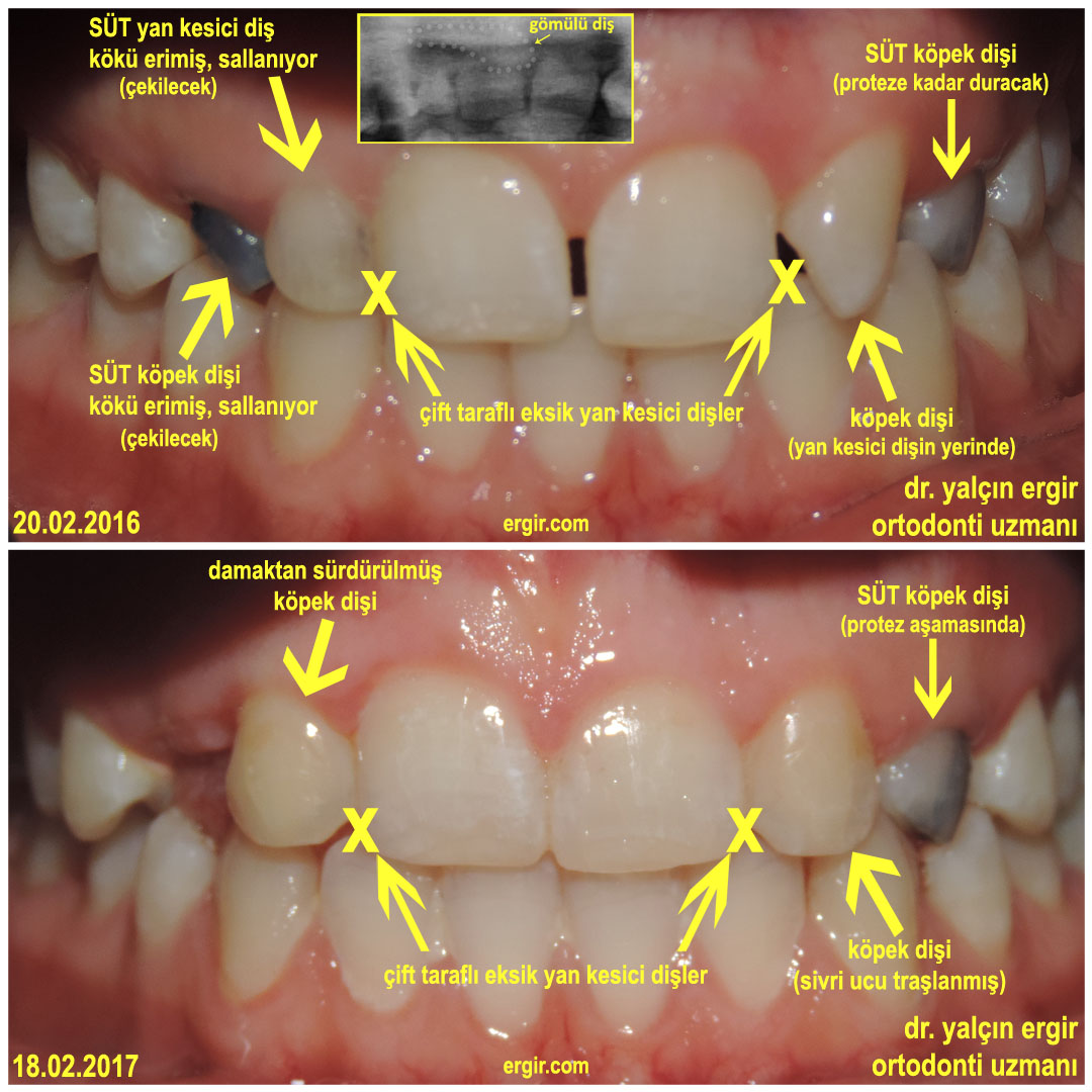 Sensiz Olmaz Bir Gomulu Dis Ortdonti Makalesi Dr Yalcin Ergir Ortodonti Uzmani
