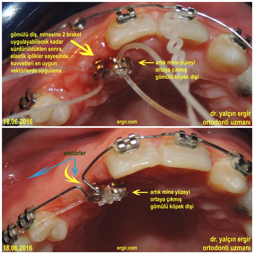 Sensiz Olmaz Bir Gomulu Dis Ortdonti Makalesi Dr Yalcin Ergir Ortodonti Uzmani