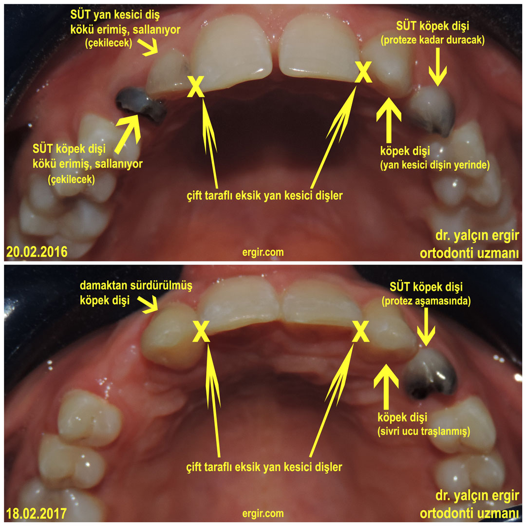 Sensiz Olmaz Bir Gomulu Dis Ortdonti Makalesi Dr Yalcin Ergir Ortodonti Uzmani