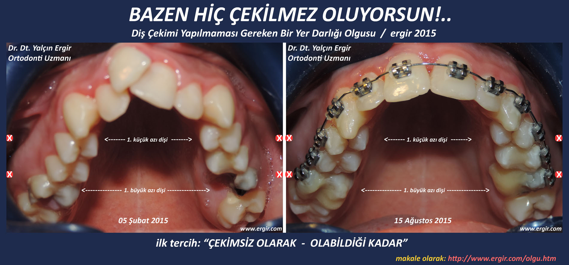 Bazen Hic Cekilmez Oluyorsdun Dr Yalcin Ergir Ortodontist Ankara